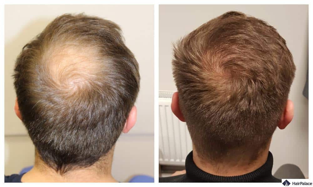 best hair transplant in lahore