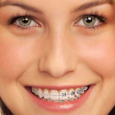 Common Myths and Facts About Wearing Dental Braces