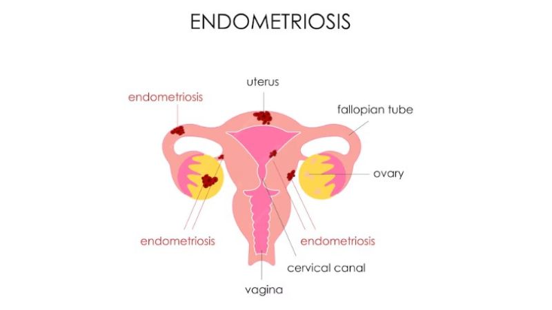 Best Endometriosis Specialist Near Me