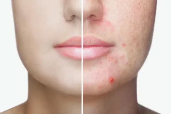 Rosacea Treatment Southampton