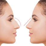 Title: Rhinoplasty in Islamabad: Your 2024 Guide to a Confident New Look