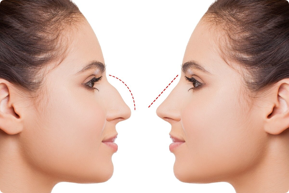 Title: Rhinoplasty in Islamabad: Your 2024 Guide to a Confident New Look