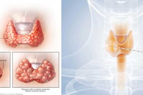 thyroid nodules