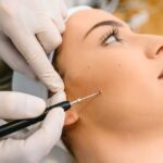 remove skin tags Sydney